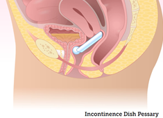 Incontinence Dish Pessary