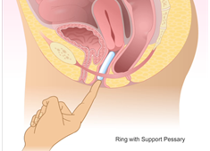 Ring with Support Pessary