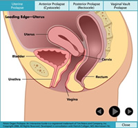 Prolapse Animation